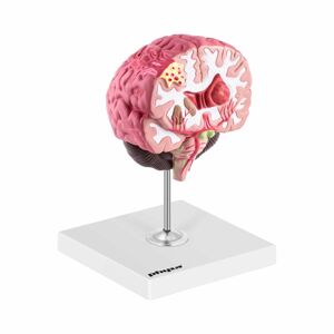 Model mozku patologický kolorovaný - Anatomické modely physa